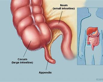 Living without an appendix causes no known health problems
