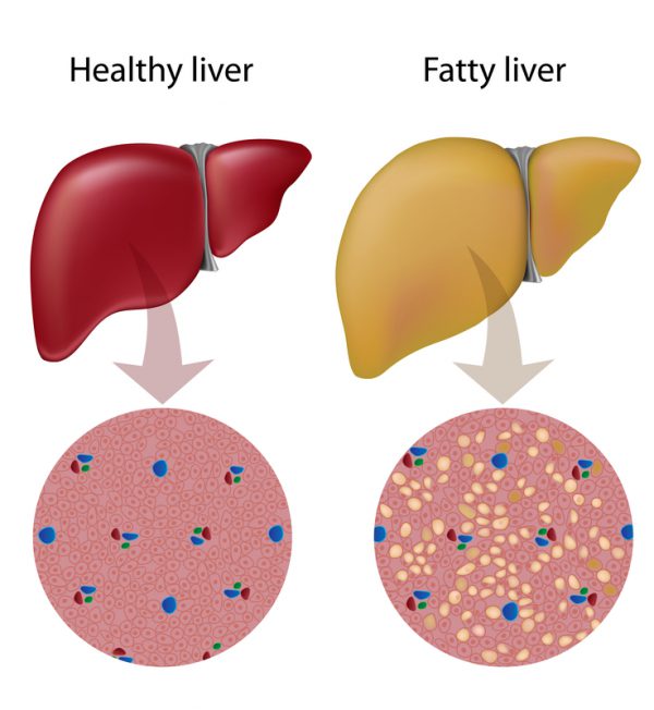 Fatty liver disease: What it is and what to do about it